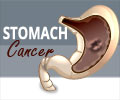 Stomach Cancer - Infographics