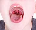 Test Your Knowledge on Tonsillitis