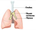Thymus Cancer