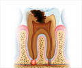 Test your Knowledge on Tooth Decay