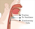 Early vs Late Tracheostomy