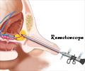 Trans-Urethral Resection of the Prostate