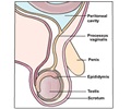 Hydrocele