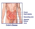 Crohns Disease