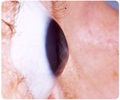 Keratoconus