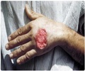 Leishmaniasis