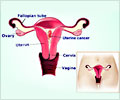 Uterine Cancer - Support Groups