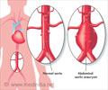 Abdominal Aortic Aneurysm