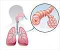 Acute Bronchitis