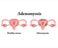 Adenomyosis or Bulky Uterus