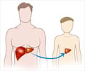Adult to Child Living Donor Liver Transplantation