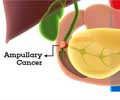 Ampullary Cancer