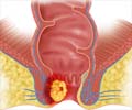 Anal Cancer | Cancer of Anal - Causes, Symptoms, Staging, Treatment, Prognosis & Prevention