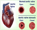 Aortic Valve Stenosis