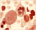 Aplastic Anemia Aplastic Anemia
