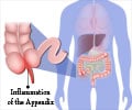 Appendicitis