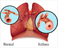 Asthma in Children and Adults
