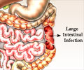 Balantidiasis