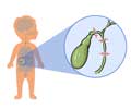 Biliary Atresia