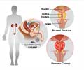 Biochemical Recurrence of Prostate Cancer