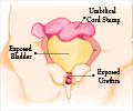 Bladder Exstrophy / Ectopia Vesicae