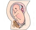 Breech Presentation and Delivery