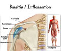 Bursitis