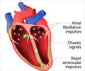 Cardiac Ablation