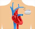 Cardiac Pacemaker for Abnormal Heart Rhythms