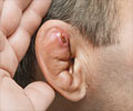 Cauliflower Ear Cauliflower Ear