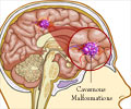 Cavernous Malformation