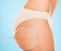 Cellulite Treatment