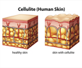 Cellulitis