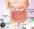 Colorectal Cancer Screening with Colonoscopy