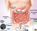 Colorectal Cancer Screening with Colonoscopy