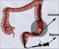 Colorectal Cancer Screening with Flexible Sigmoidoscopy Colorectal Cancer Screening with Flexible Sigmoidoscopy