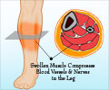 Compartment Syndrome