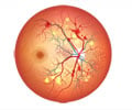 Diabetic Retinopathy