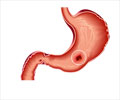 Diet for Peptic Ulcer (Stomach ulcers)