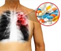 Drug-induced Pulmonary Diseases