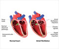 Drugs for Atrial Fibrillation Drugs for Atrial Fibrillation