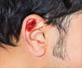 Cancers of the Ear / Ear Cancers