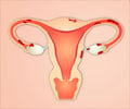 Endometriosis - Support Groups