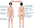 Fibromyalgia