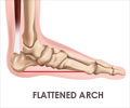 Flat Feet / Pes Planus