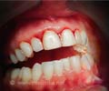 Gingival Hyperplasia / Gingival Enlargement