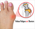 Halus Valgus