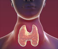 Hashimotos Thyroiditis