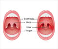 Herpangina (Painful Mouth Infection)