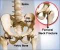 Hip Fracture